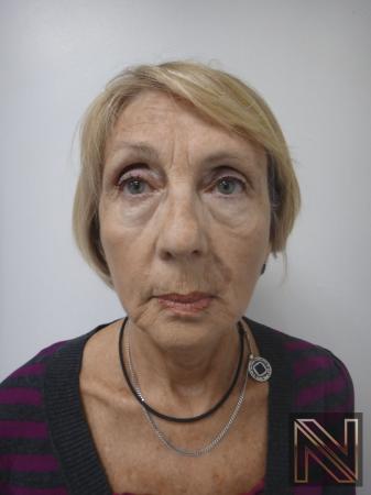Ultherapy®: Patient 2 - After 1