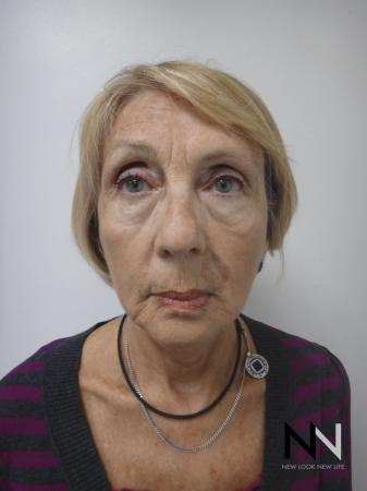 Ultherapy®: Patient 2 - After Image 1