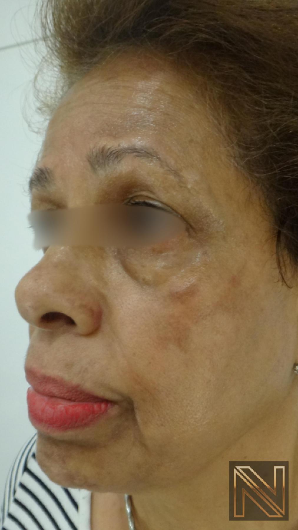 Laser Skin Resurfacing - Face: Patient 2 - Before 2