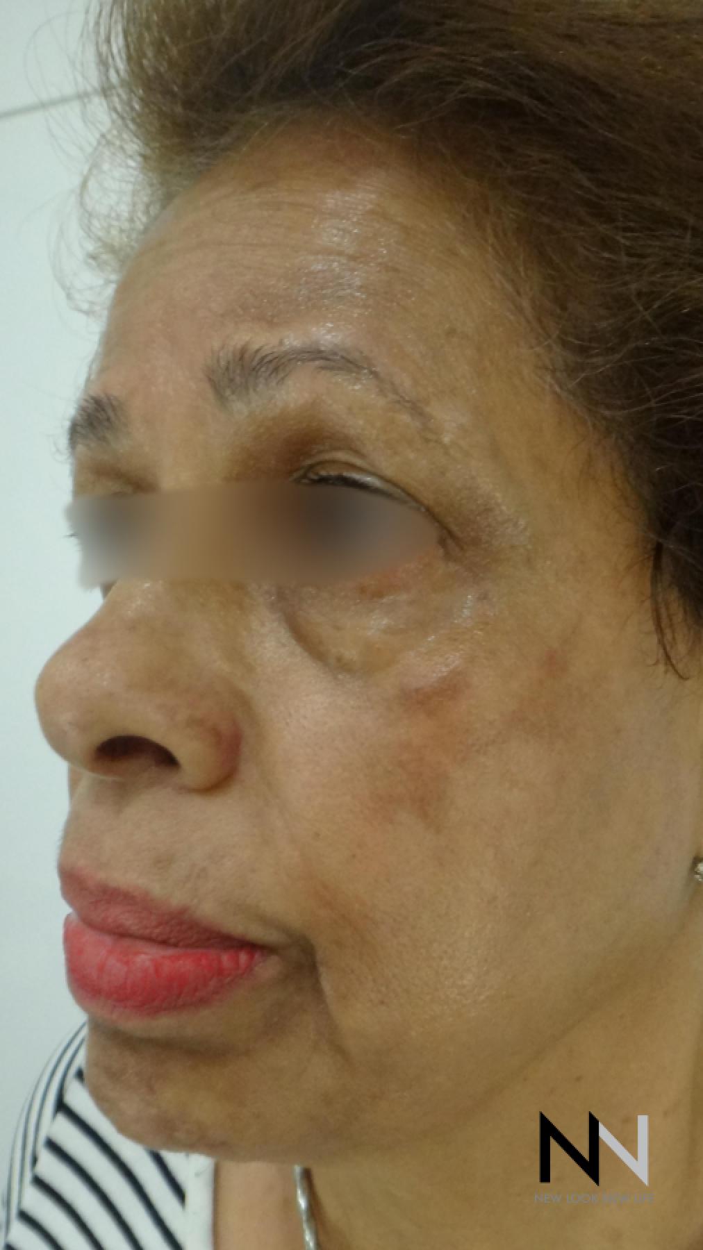 Laser Skin Resurfacing - Face: Patient 2 - Before 2