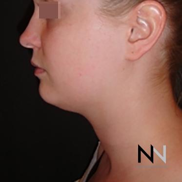 Liposuction: Patient 1 - Before Image 4
