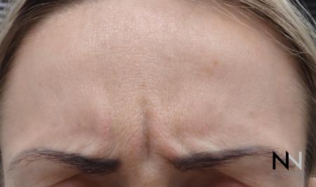 Dysport® : Patient 13 - Before Image 1