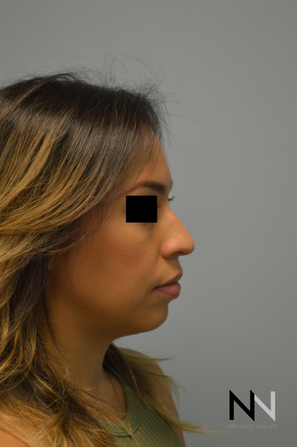 Rhinoplasty: Patient 6 - Before 3