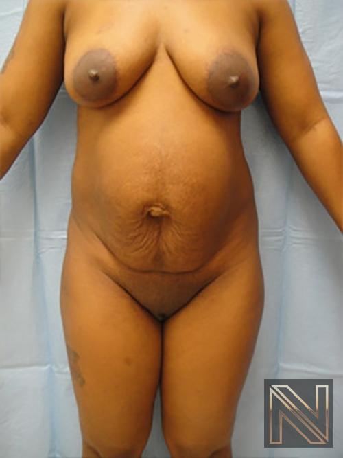 Abdominoplasty: Patient 7 - Before 1