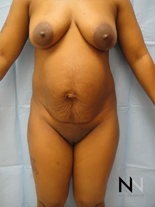 Abdominoplasty: Patient 7 - Before 1