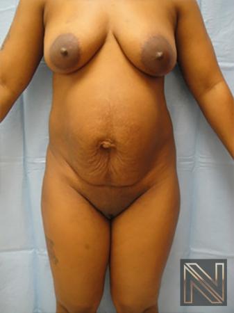 Abdominoplasty: Patient 7 - Before 