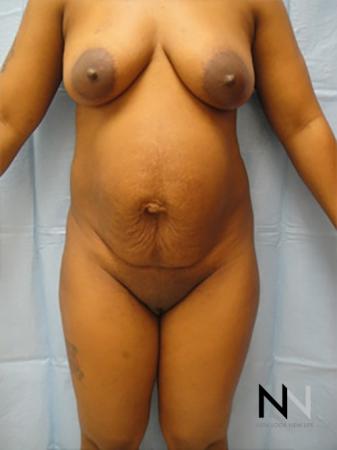 Abdominoplasty: Patient 7 - Before Image 1