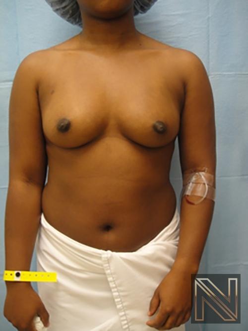 Breast Augmentation: Patient 12 - Before 1
