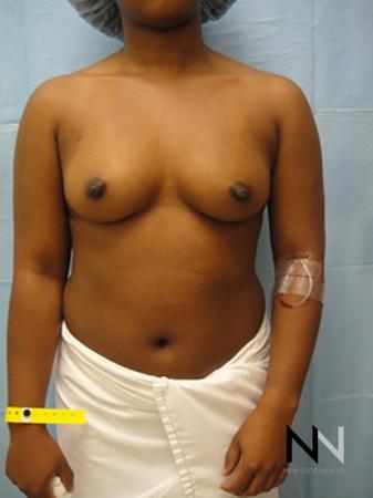 Breast Augmentation: Patient 12 - Before Image 1