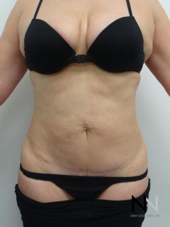 Mini Tummy Tuck: Patient 7 - After Image 1
