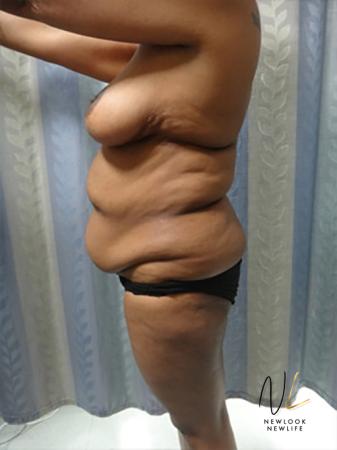 Abdominoplasty: Patient 8 - Before Image 2