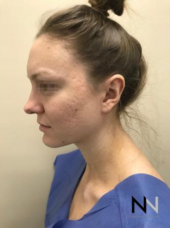 Fractional Resurfacing: Patient 4 - Before Image 1