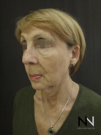 Ultherapy®: Patient 2 - Before Image 4