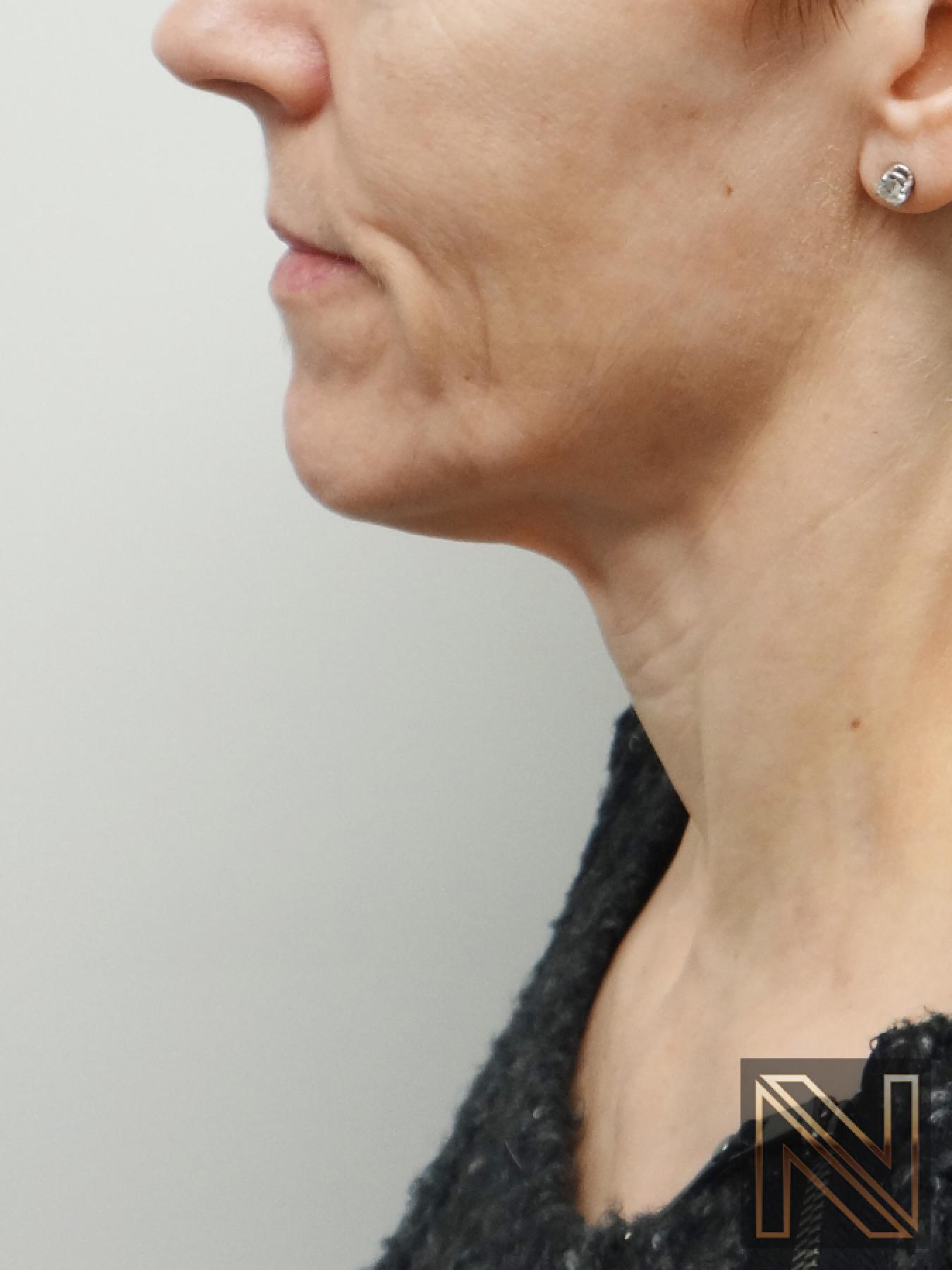 Ultherapy®: Patient 1 - Before 1