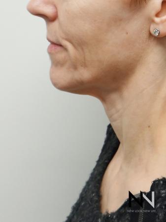 Ultherapy®: Patient 1 - Before 1