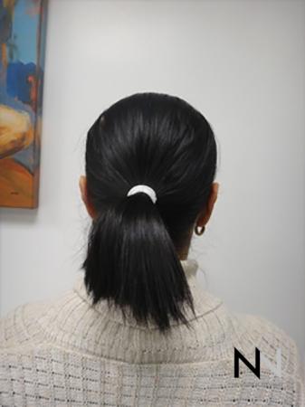Otoplasty And Earlobe Repair: Patient 5 - After Image 1