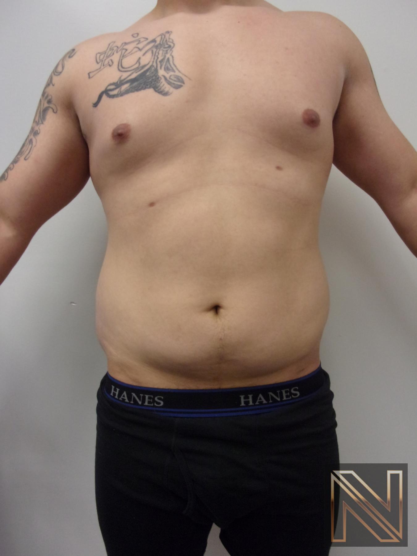Liposuction: Patient 14 - Before 1
