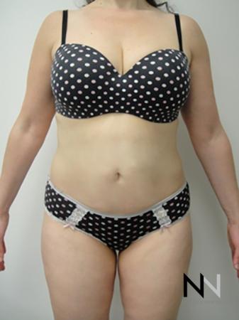 Liposuction: Patient 5 - After Image 1