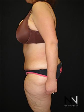 Abdominoplasty: Patient 19 - After 2