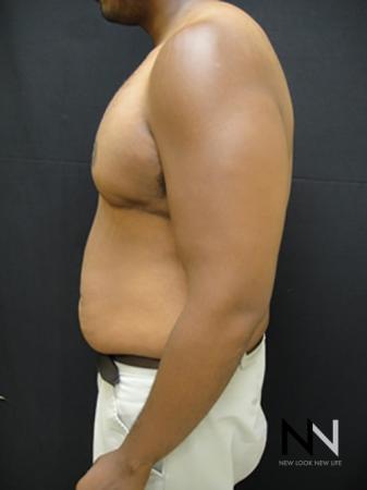 Gynecomastia: Patient 1 - After Image 4