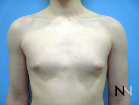 Gynecomastia: Patient 8 - Before Image 1