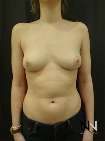 Inverted Nipple Surgery: Patient 3 - Before Image 1