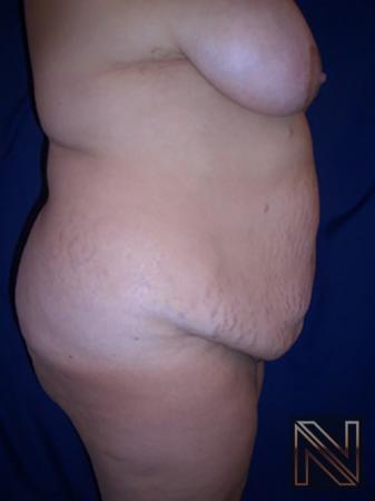 Abdominoplasty: Patient 4 - Before and After 3