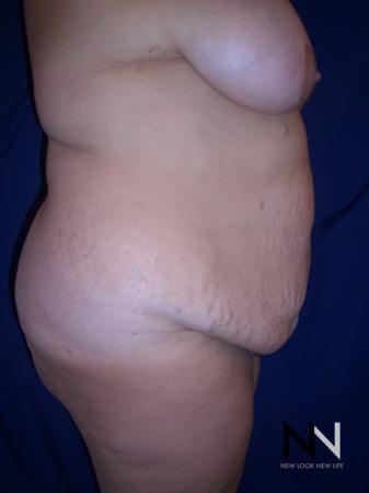Abdominoplasty: Patient 4 - Before and After Image 3