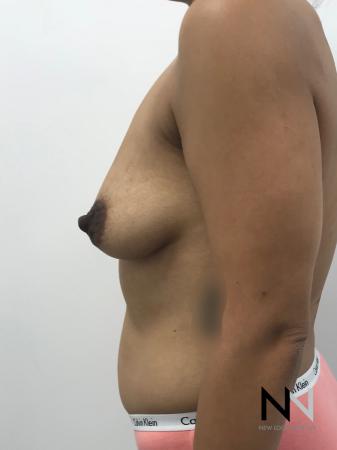 Breast Lift: Patient 1 - Before and After Image 5