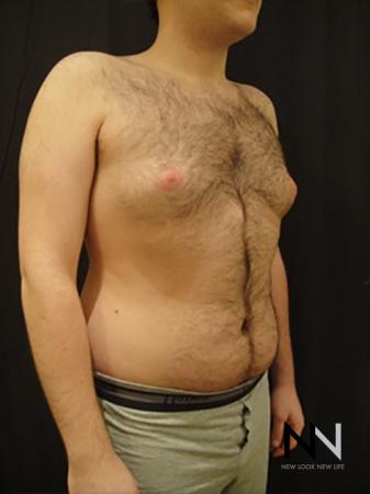Gynecomastia: Patient 5 - Before Image 3