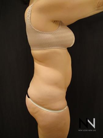 Liposuction: Patient 5 - Before Image 3