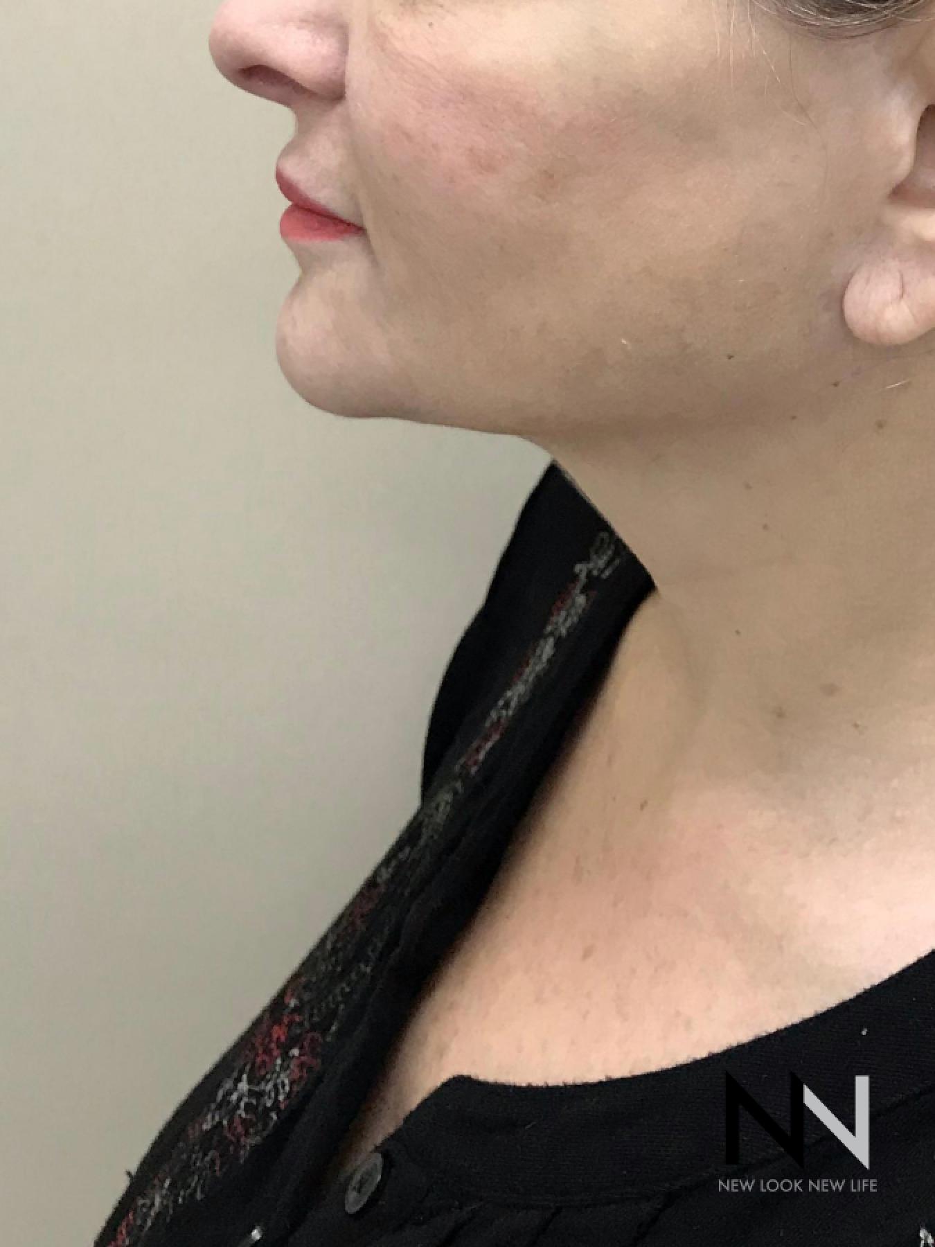 Facelift/Mini Facelift: Patient 8 - After  