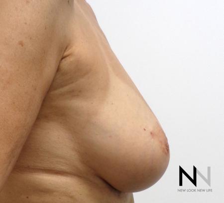 Fat Transfer - Body: Patient 1 - After Image 4