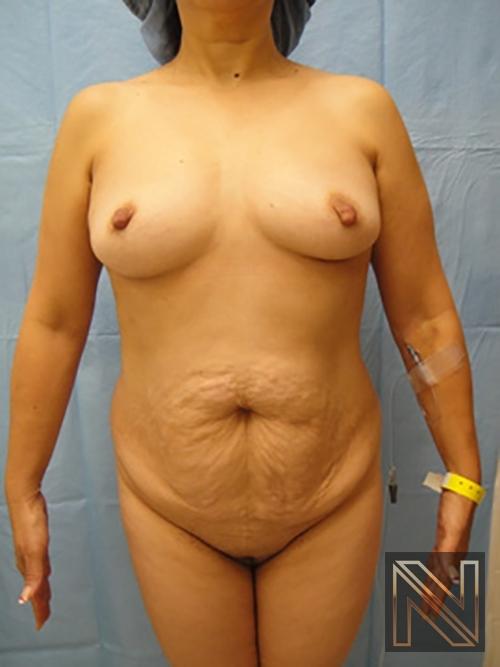 Abdominoplasty: Patient 6 - Before 1