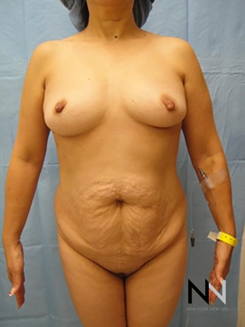 Abdominoplasty: Patient 6 - Before 