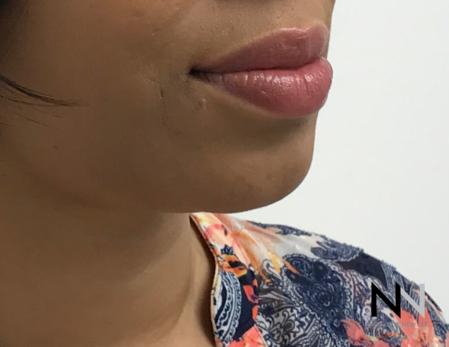 Chin Augmentation: Patient 3 - After Image 1