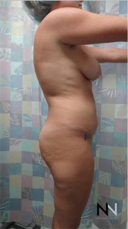 Butt Augmentation: Patient 3 - Before Image 3