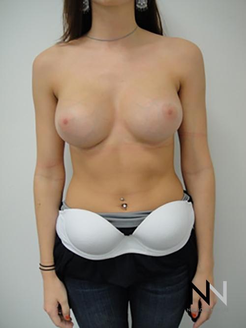 Breast Augmentation: Patient 6 - After  