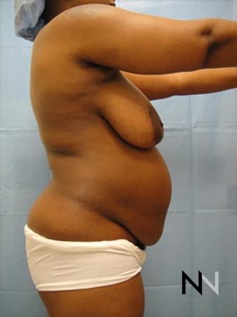 Abdominoplasty: Patient 10 - Before and After 3