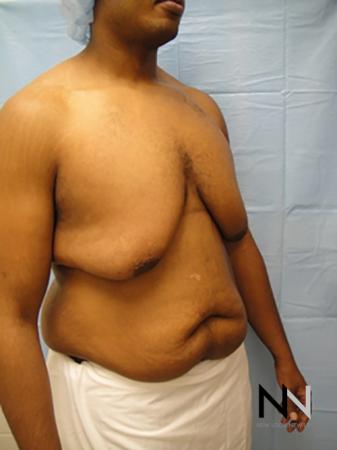 Gynecomastia: Patient 1 - Before Image 3