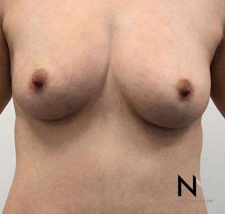 Fat Transfer - Body: Patient 2 - Before and After Image 5