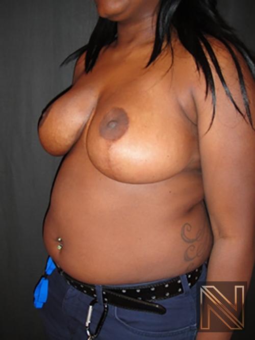 Breast Reduction: Patient 6 - After 2