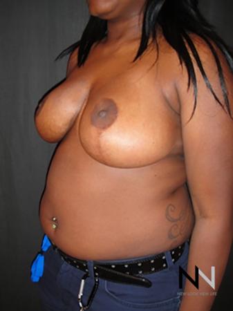 Breast Reduction: Patient 6 - After Image 2