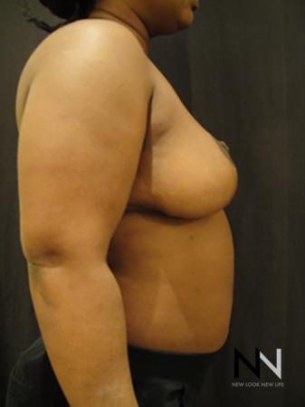 Breast Reduction: Patient 3 - After Image 5