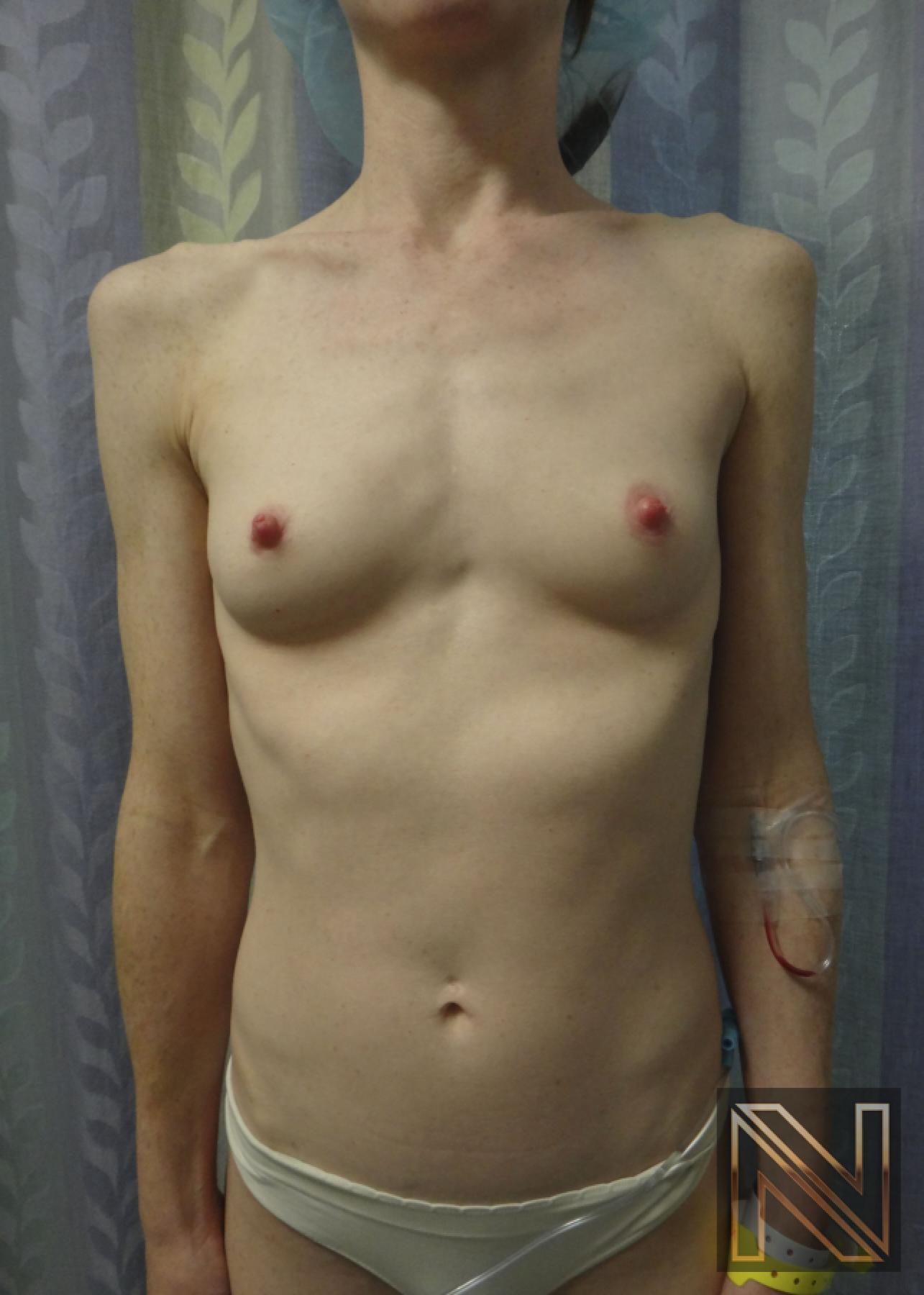 Breast Augmentation: Patient 17 - Before 1