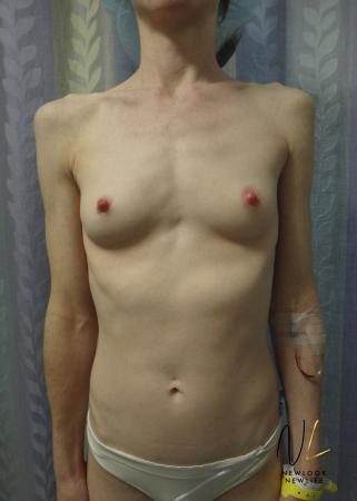 Breast Augmentation: Patient 17 - Before Image 1