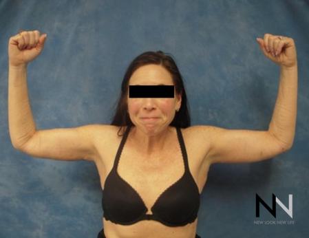 Brachioplasty: Patient 2 - After Image 1