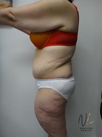 Abdominoplasty: Patient 12 - After 2