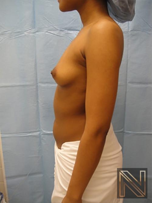 Breast Augmentation: Patient 14 - Before and After 4