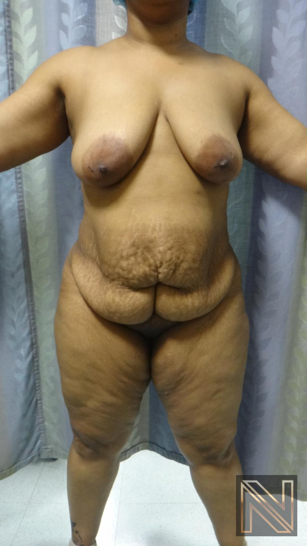 Abdominoplasty: Patient 23 - Before 1